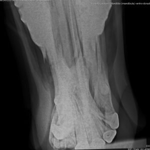 5_llegada_fractura_bilateral_madibula